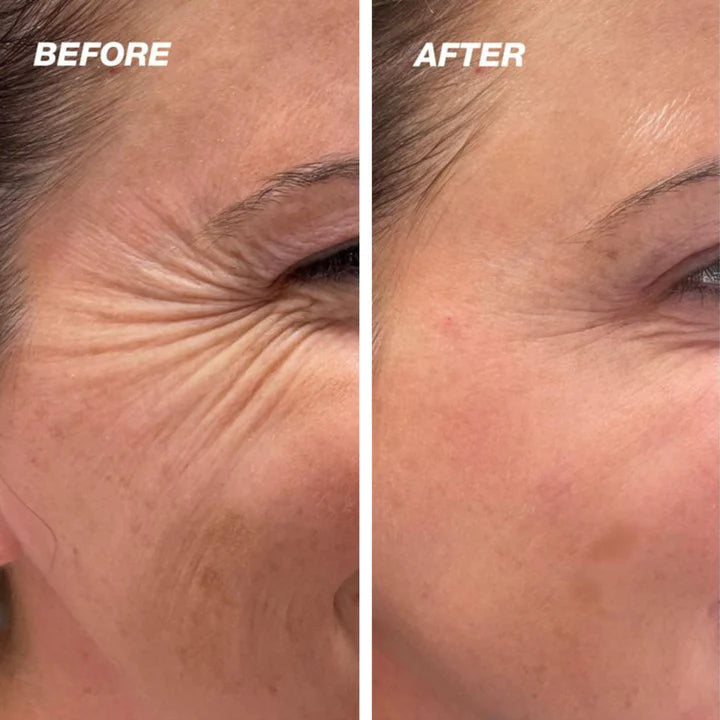 ScarEase™ Collagen Recovery Tape