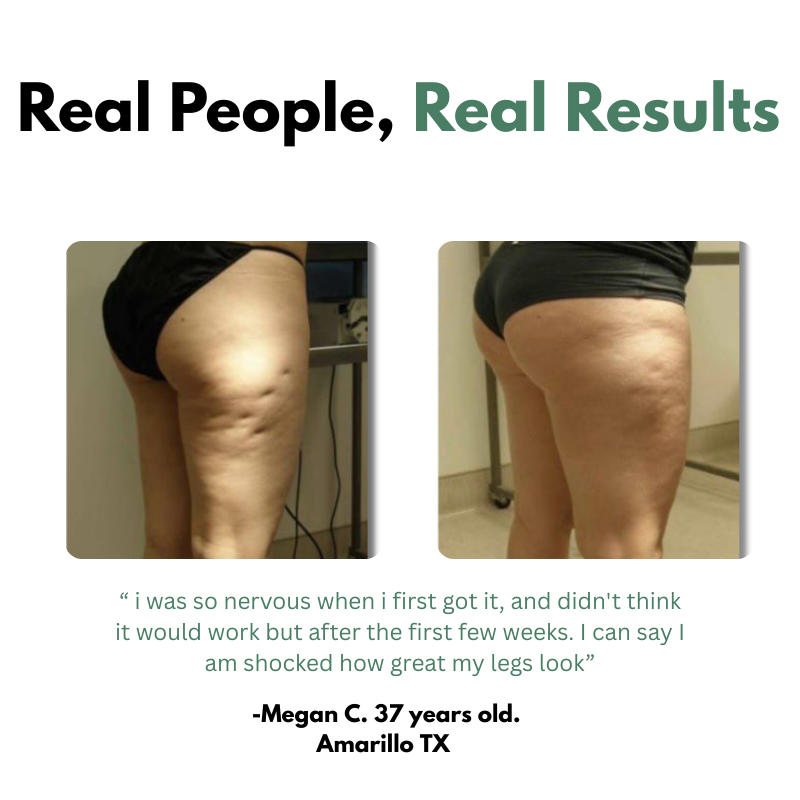 VeroGlide™ Cellulite Massager