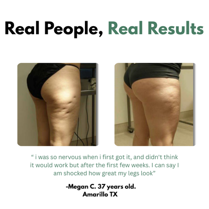 VeroGlide™ Cellulite Massager